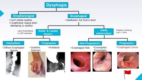 esophageal cancer differential diagnosis